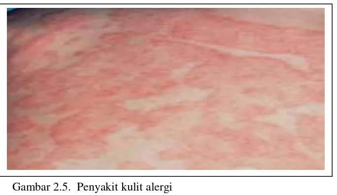 Gambar 2.5.  Penyakit kulit alergi 