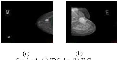 Gambar 1a, 1b,  berturut turut adalah gambar mammogram IDC dan ILC.  