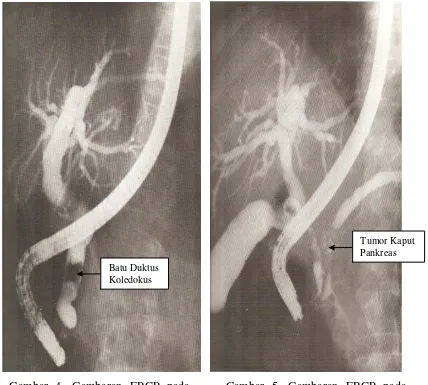 Gambar 5. Gambaran ERCP pada ikterus obstruktif karena tumor kaput pankreas (dikutip dari Pott dan Schrameyer 1995) 