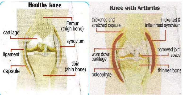 Gambar 1. A Kiri : Gambar Sendi Lutut Normal.B. Kanan :gambar sendi lutut yang mengalami osteoartritis