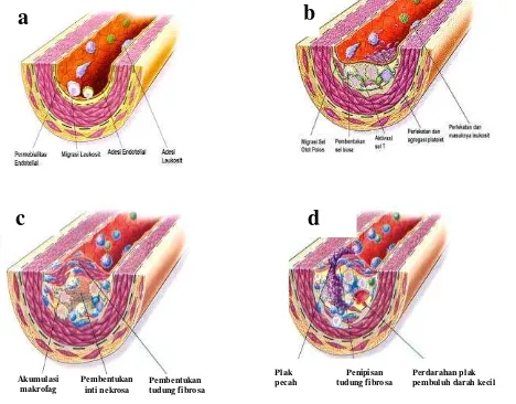 Gambar 7 Respon kelukaan pada proses aterosklerosis (Ross 1993). 