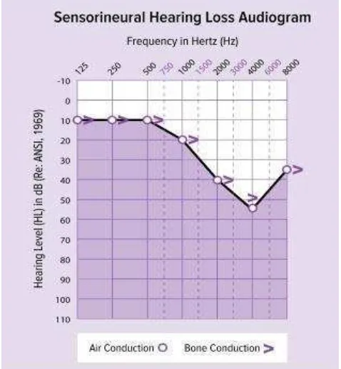 Gambar 2.4.2 Sensorineural Hearing Loss Audiogram 