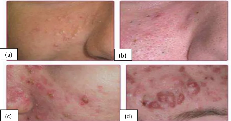 Gambar 2. 2 Lesi akne vulgaris (Goldsmith et al., 2012) 