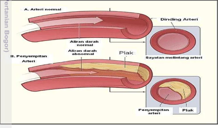 Gambar  1  Proses terjadinya aterosklerosis (Sumber: Nelms et al. 2010) 