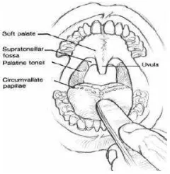 Gambar 2.2 Tonsil pada pemeriksaan orofaring (Lowry dan Onart, 2003) 