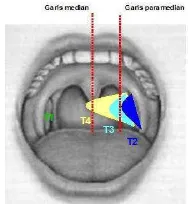 Gambar 2.9 Batas pembesaran tonsil (Adams, 2010; Jeyakumar, dkk., 2013) 