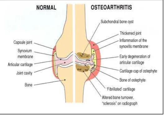 Gambar 2.1.  Lutut Normal dan Lutut Osteoarthritis 