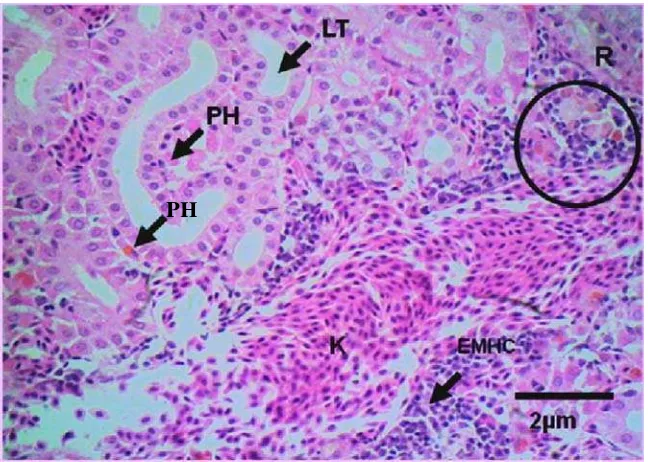 Gambar 27.    Lesio pada ginjal berupa infiltrasi  sel radang (SR), droplet hialin (DH) 