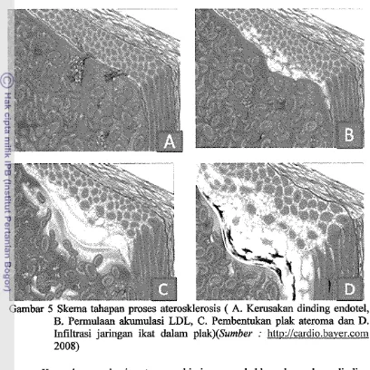 Gambar 5 Skema tahapan proses aterosklerosis ( A. Kerusakan dinding endotel, 
