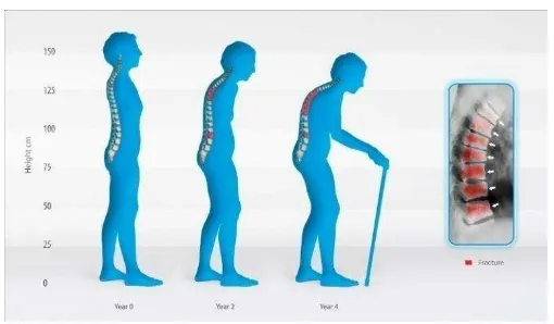 Gambar 2.3    Perubahan bentuk tubuh yang diakibatkan osteoporosis 
