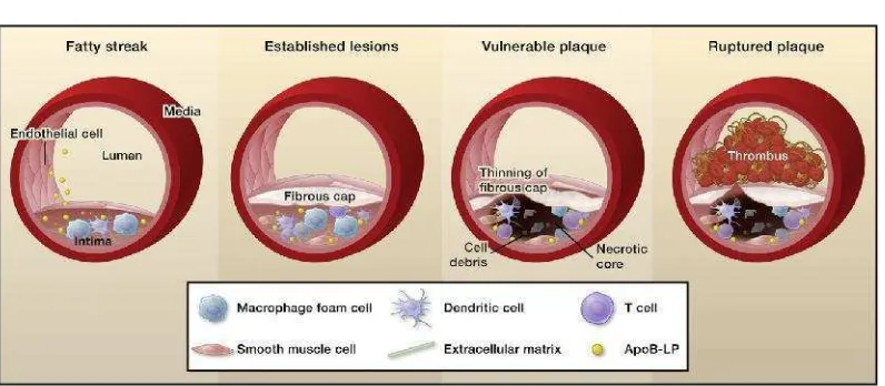 Gambar 5. Progresivitas atherosklerosis (Moore & Tabas, 2011)