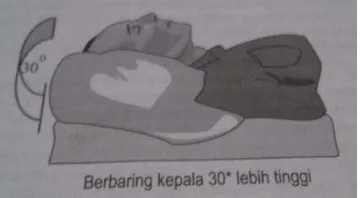 Gambar 2.7 Posisi Berbaring bagi Penderita Pasca-Stroke  Sumber: (Iskandar, 2004) 