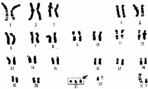 Figure 2.1: Karyotype of a child with Down syndrome or Trisomy 21 