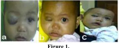 Figure 1. a.first case when first came to ophthalmologist; b.a month after TA injection; c.four months after TA injection 