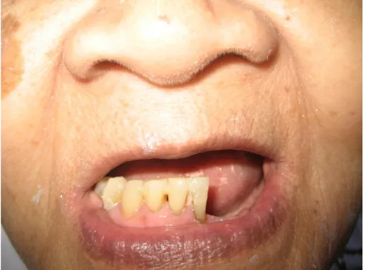 Gambar 3. Intra oral rahang atas dengan gigi tiruan