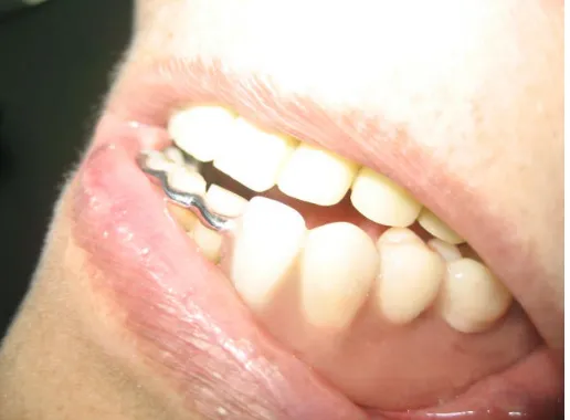 Gambar 10. Gigi tiruan setelah dipasang pada mulut pasien
