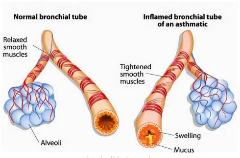 Gambar 3. Perbedaan  dinding bronkial normal dan asma (sumber: http://www.duniainformasikesehatan.com) 