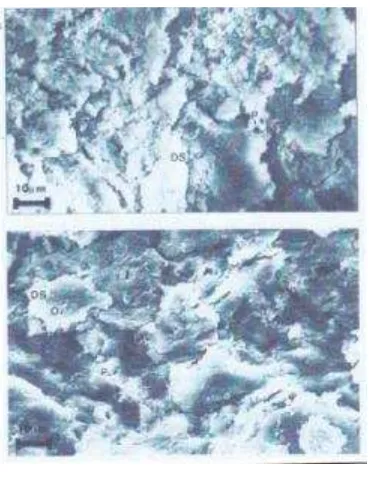 Gambar 2 : Permukaan dentin setelah pembuangan karies dengan metode Chemo-mechanical caries removal5 