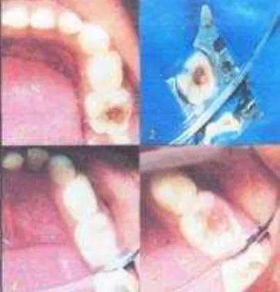 Gambar 3 : Prosedur pembuangan karies gigi menggunakan Carisolv pada gigi sulung posterior 6 