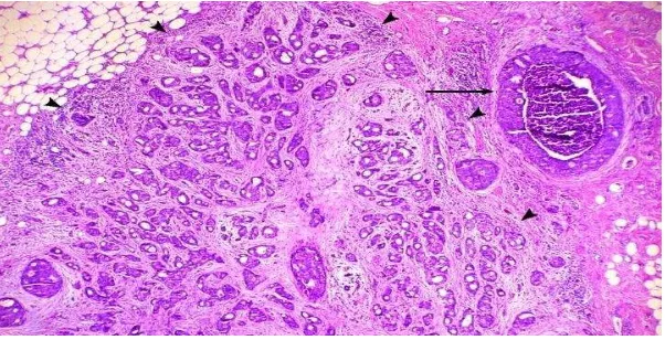 Gambar 4. Invasive Ductal Carcinoma Perbesaran 4x  (Kumar et al., 2007) 