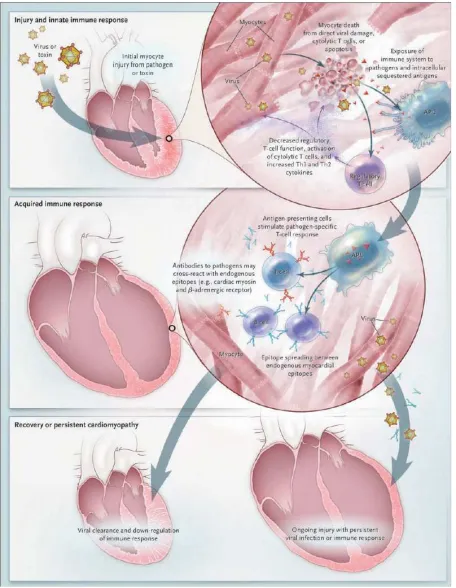 Gambar. Perjalanan patogenesis miokarditis