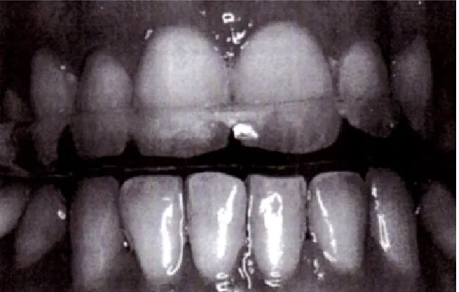 Gambar 3. Bite splint28.