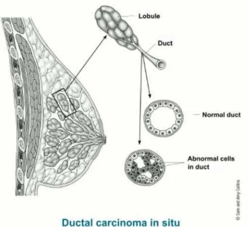 Gambar 3. Karsinoma Duktal In Situ (Sumber: America Cancer Society, 2013)