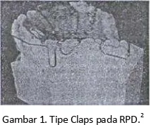 Gambar 1. Tipe Claps pada RPD.2