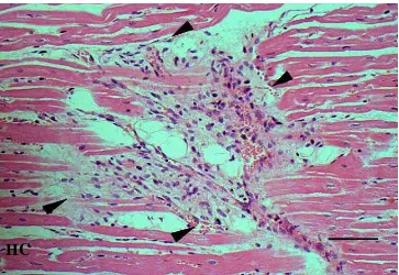 Gambar 38.  Infiltrasi sel radang limfositik pada bagian epikardium (tanda kepala anak  panah)