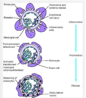 Gambar 2 Peran berbagai sel dalam terjadinya glomerulosklerosisSumber: Nahas, 2003