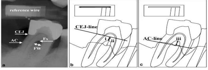 Gambar 4. (a-c) Kelas II Cacat furkasi pada aspek lingual molar pertama mandibula kanan  