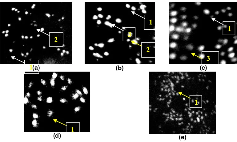 Gambar 3–Morfologi sel T47D akibat perlakuan ekstrak (a) konsentrasi 200µg/ml (b) 300 µg/ml (c) 400 µg/ml (d) kontrol pelarut dan (e) kontrol sel, setelah pengecatan dengan menggunakan double staining akridin oranye-etidium bromida