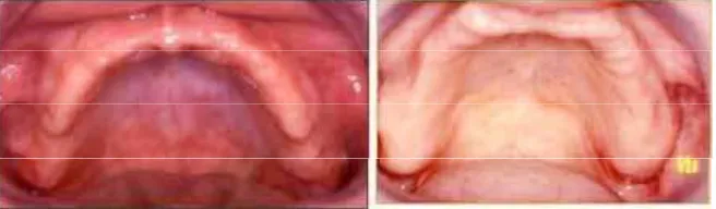 Gambar 5. (5a). Aspek klinis palatal dengan stomatitis (classe II Budtz Jorgensen) dan (5b)