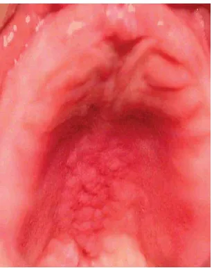 Gambar 6. Kandidiasis eritematosa dengan eritema lokal (pada daerah yang tertutup oleh gigi tiruan) (McCullough & Savage, 2005)