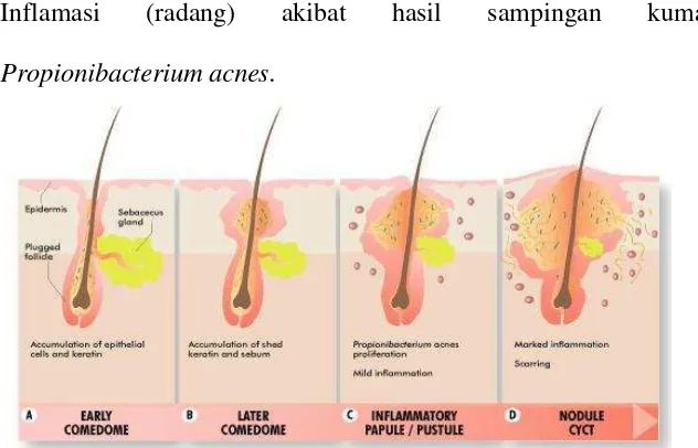 Gambar 2. Patogenesis akne . (Adhi et al.,2008) 