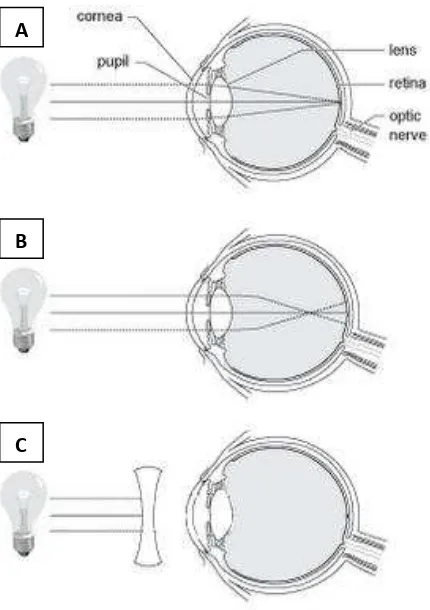 Gambar A menjelaskan tentang jalannya sinar pada mata normal. 