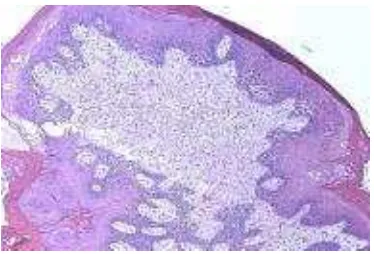Gambar 2.2 Gambaran histopatologi skin tag. (Weedon, 2010) 