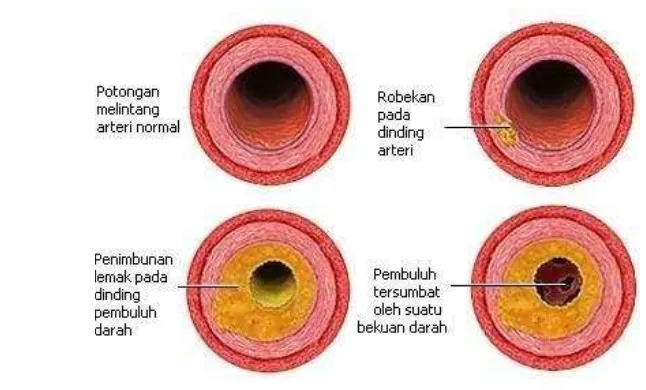 Gambar 2  Plak aterosklerosis pada pembuluh darah 