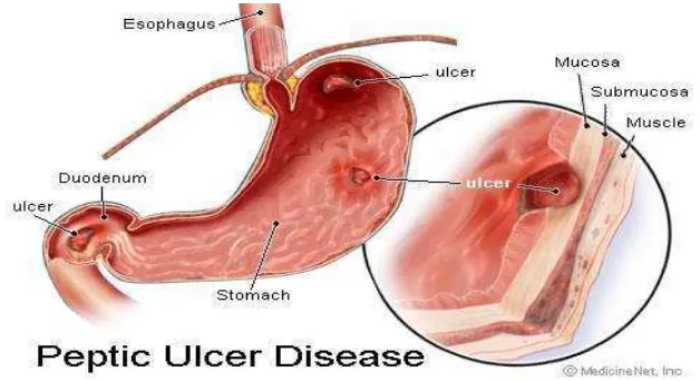 Gambar 2.1. Peptic Ulcer 