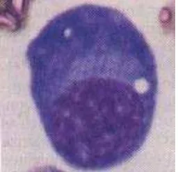 Gambar 2.6  A. Plasmacytoma pada soft tissuemultiple myeloma; B. Aspirasi sumsum tulang , sel-sel plasma dan plasmablas menggantikan jaringan hematopoesis normal (Bernadette and Rodak, 2002) 