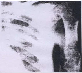 Gambar 2.8  Lesi osteolitik pada os humerus dekstra (Beutler, 2001).  