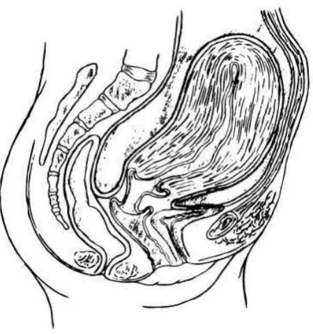 Gambar 5. Uterus pasca persalinan  (Sumber : The Acquire Project, 2008) 