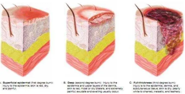 Gambar 2. A. Luka Superfisial, B. Luka Full Partial-thickness, C. Luka thickness. (Sumber: http://intranet.tdmu.edu.ua/data/kafedra/ internal/i_nurse/)