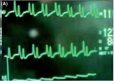 Gambar 2.4 EKG intraatrial yang menunjukan gelombang P atrial ( Gelombang P 
