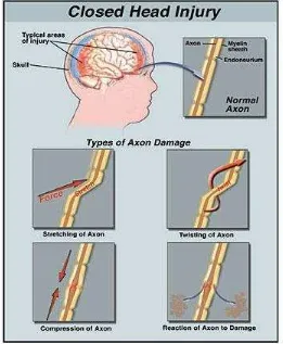 Gambar 02.  Neuronal damage (Paragon SC, 2008)