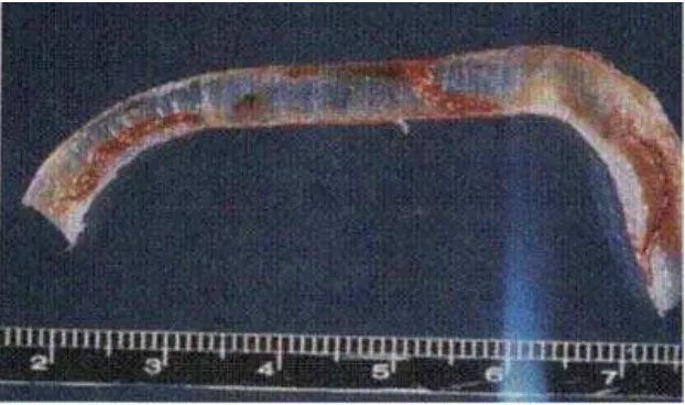 Gambar 1. Cacing Syngamus Trakhea di dalam Trakhea ayam kampung                   (Tabbu, 2002) 