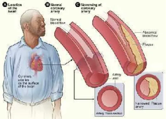 Gambar 3. Diagram aterosklerosis (sumber: http://www.nhlbi.nih.gov)