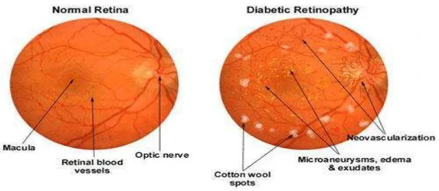 Gambar 2. Perbedaan retina normal dan retina pada RD  (Arloa Eye Associate, 2016) 