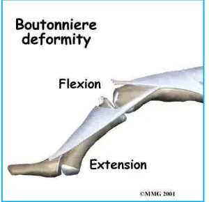 Gambar 2.16: Boutonniere Deformity (Sumber: www.mdguidelines.com jam 14.09) 