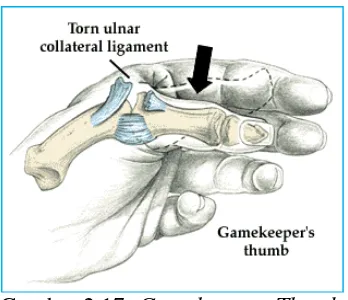 Gambar 2.17: Gamekeepers Thumb (Sumber: www.mdguidelines.com jam 14.12) 